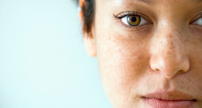 Melasma: saiba o que provoca e  como tratar o pesadelo das mulheres