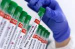 Sindjori: Uberlândia tem 52 casos de varíola dos macacos