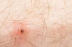 Febre maculosa: o que fazer se for picado pelo carrapato que causa a doença?